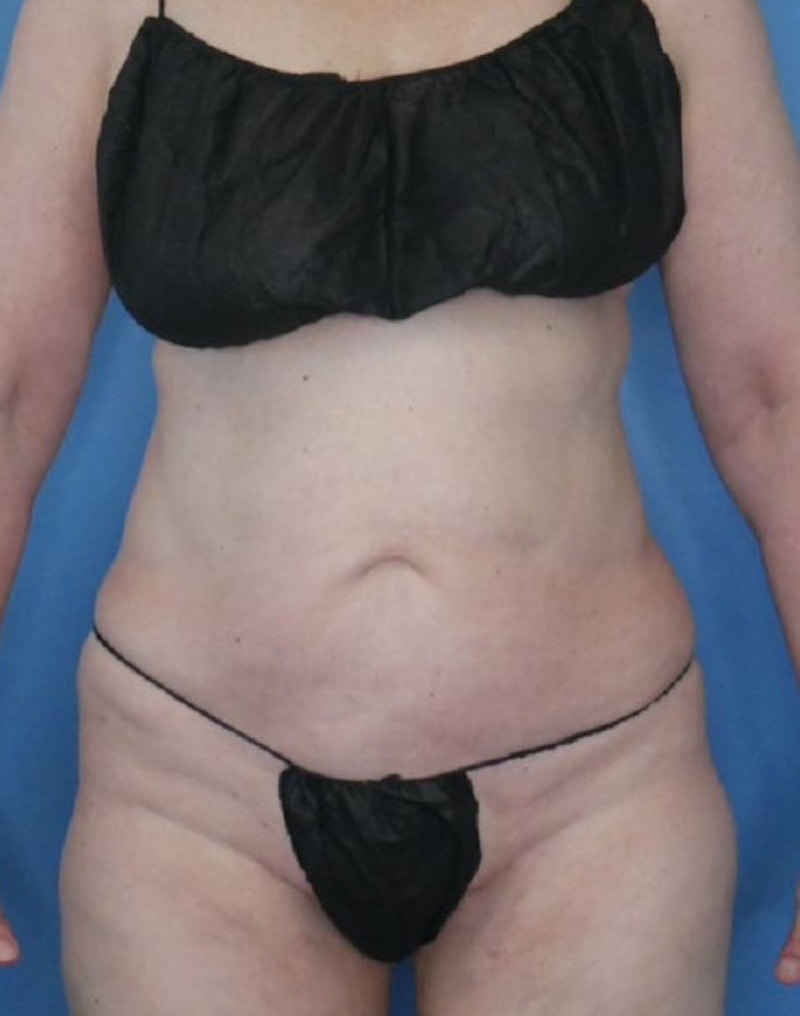 Vaser Liposuction Before & After Gallery - Patient 86645071 - Image 2