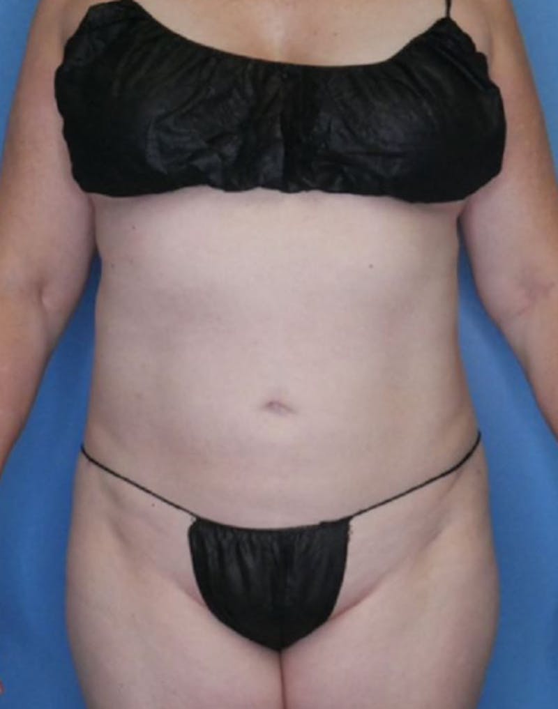 Vaser Liposuction Before & After Gallery - Patient 86645072 - Image 2