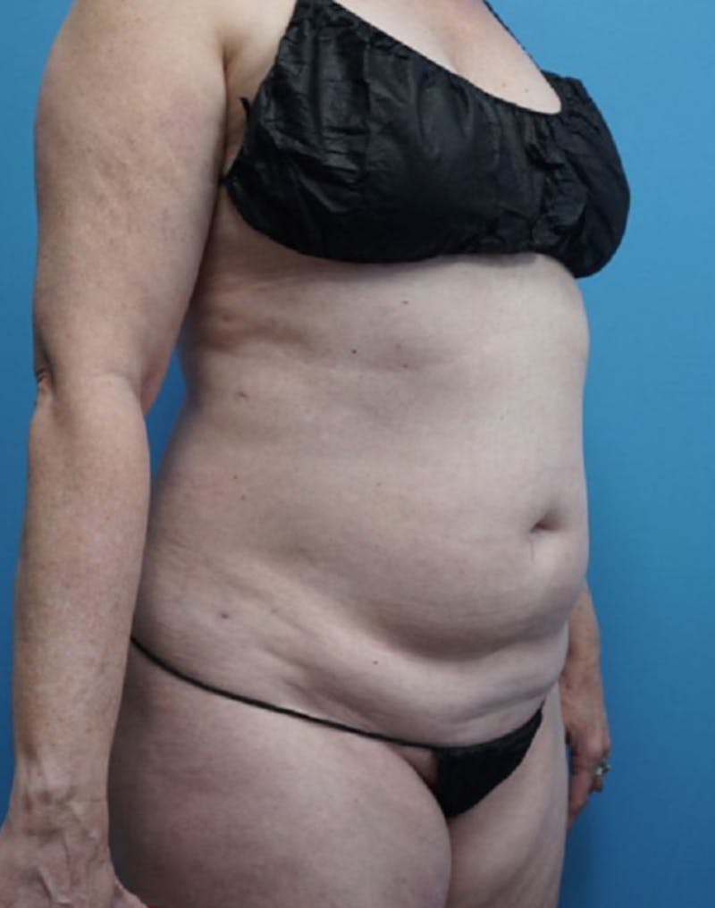 Vaser Liposuction Before & After Gallery - Patient 86645072 - Image 3
