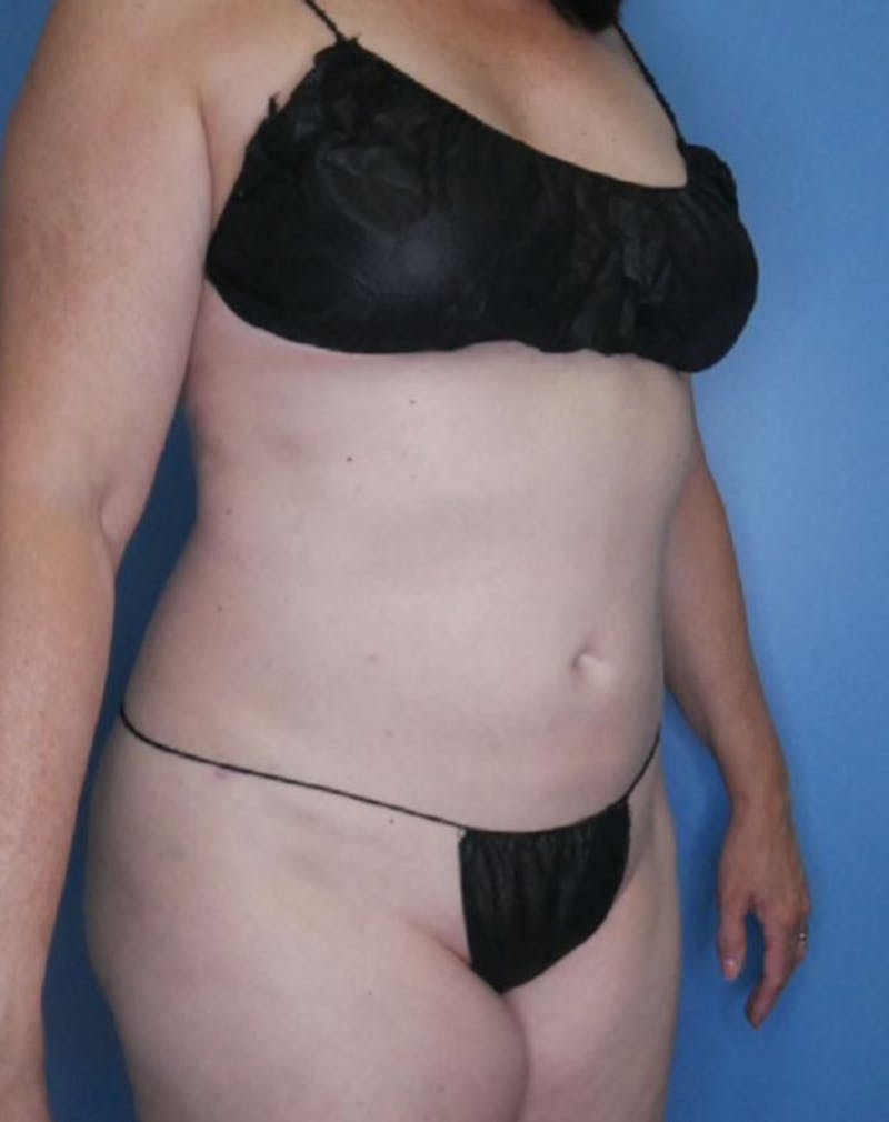 Vaser Liposuction Before & After Gallery - Patient 86645072 - Image 4