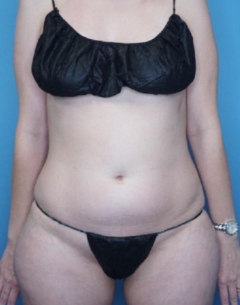 Vaser Liposuction Before & After Gallery - Patient 86645093 - Image 2