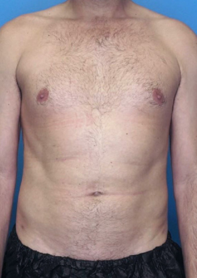 Vaser Liposuction Before & After Gallery - Patient 86645106 - Image 2