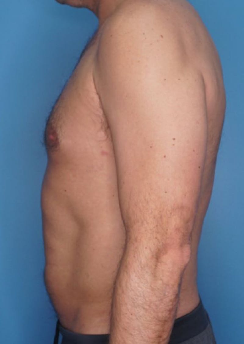 Vaser Liposuction Before & After Gallery - Patient 86645106 - Image 3