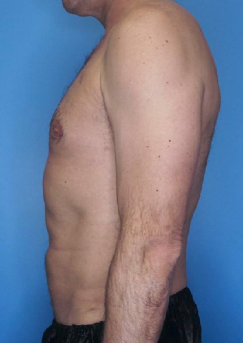 Vaser Liposuction Before & After Gallery - Patient 86645106 - Image 4