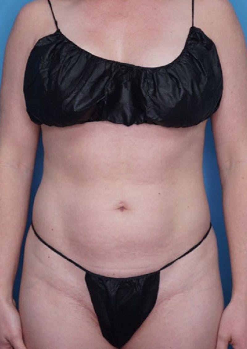 Vaser Liposuction Before & After Gallery - Patient 86764305 - Image 1