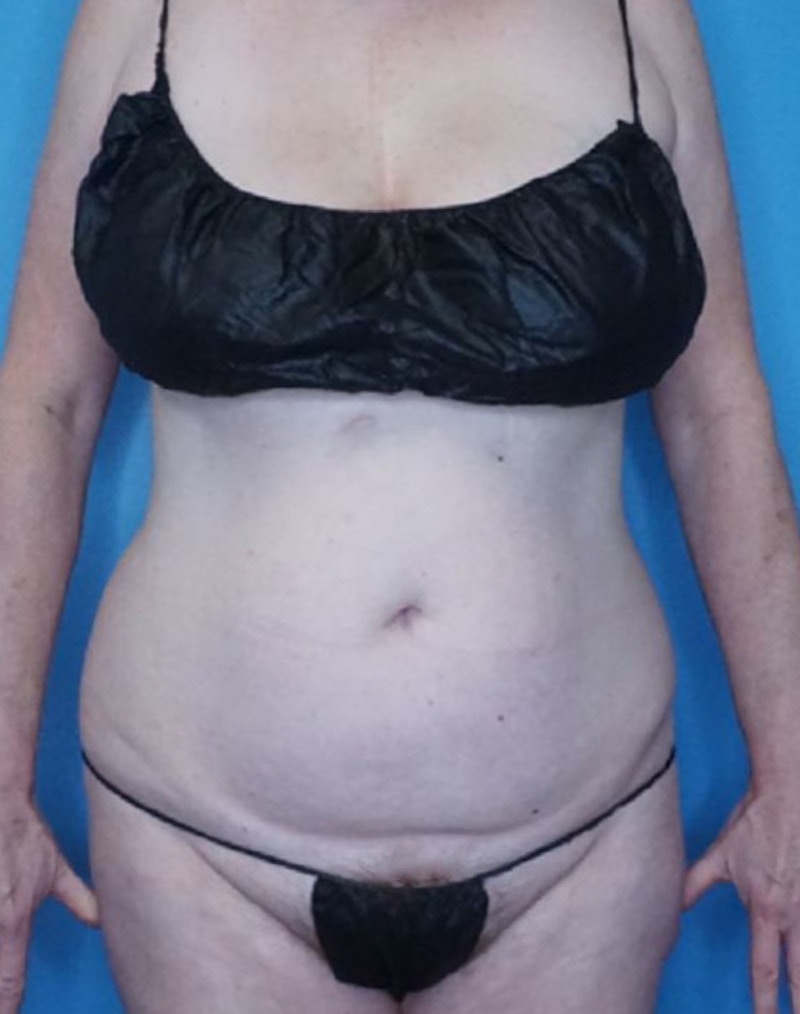 Vaser Liposuction Before & After Gallery - Patient 86806861 - Image 1