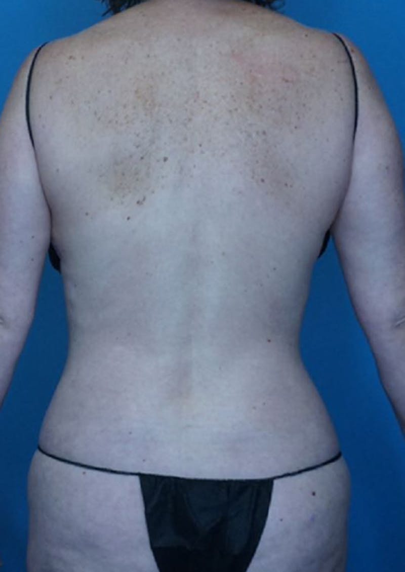 Vaser Liposuction Before & After Gallery - Patient 86806861 - Image 4