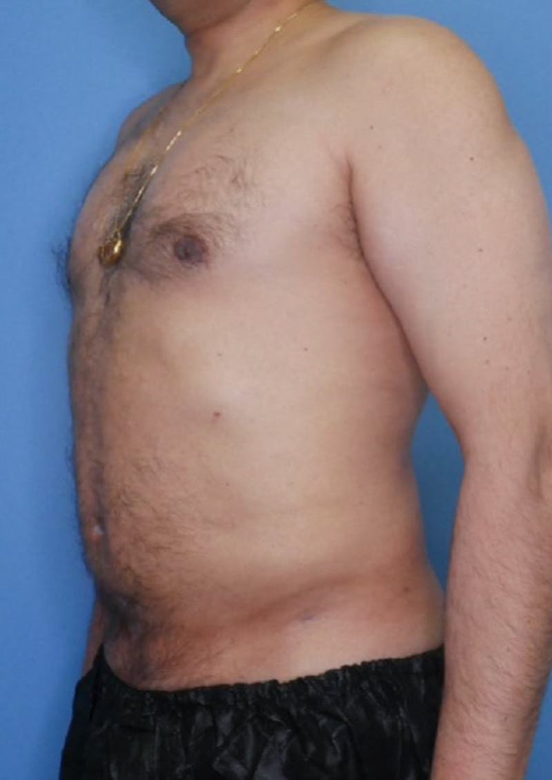 Vaser Liposuction Before & After Gallery - Patient 86837155 - Image 2