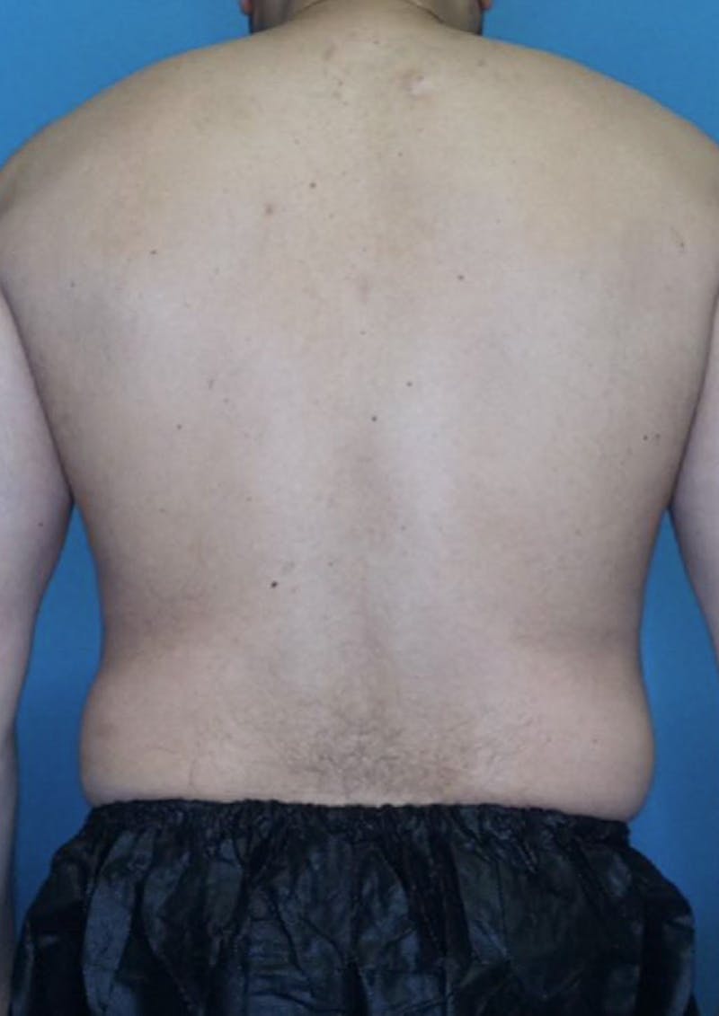 Vaser Liposuction Before & After Gallery - Patient 86837155 - Image 3