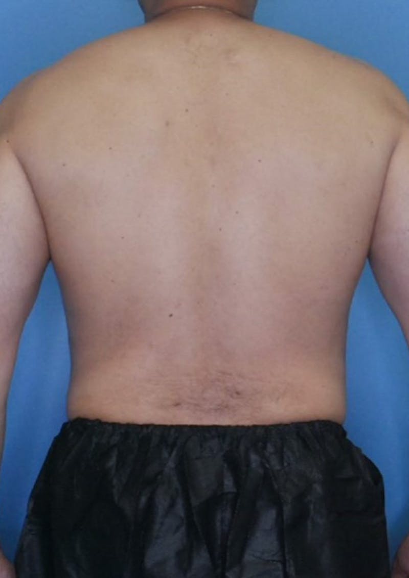 Vaser Liposuction Before & After Gallery - Patient 86837155 - Image 4