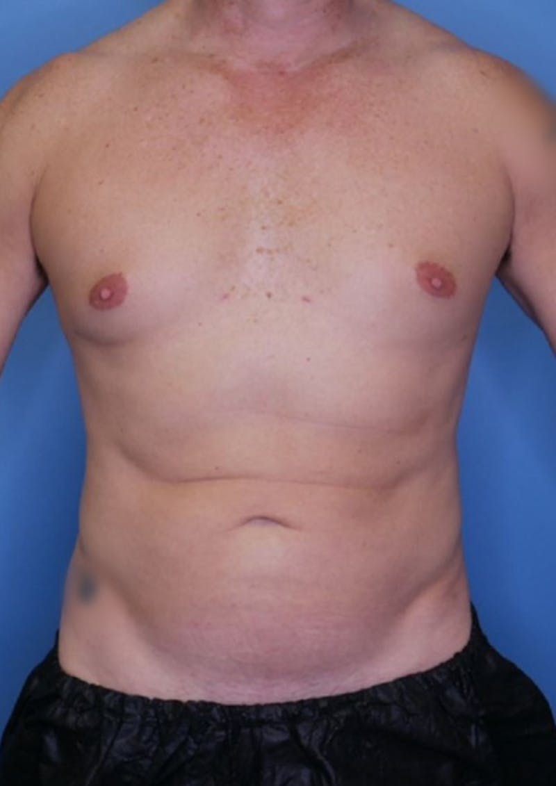 Vaser Liposuction Before & After Gallery - Patient 86837227 - Image 2