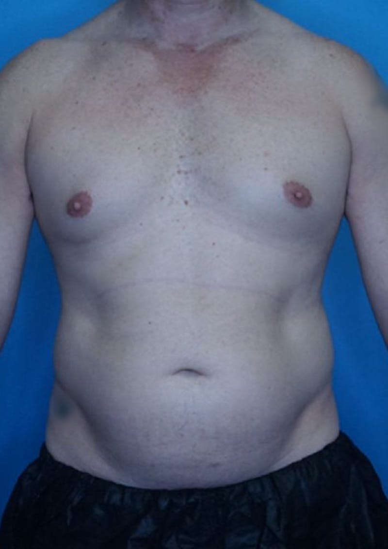 Vaser Liposuction Before & After Gallery - Patient 86837227 - Image 1