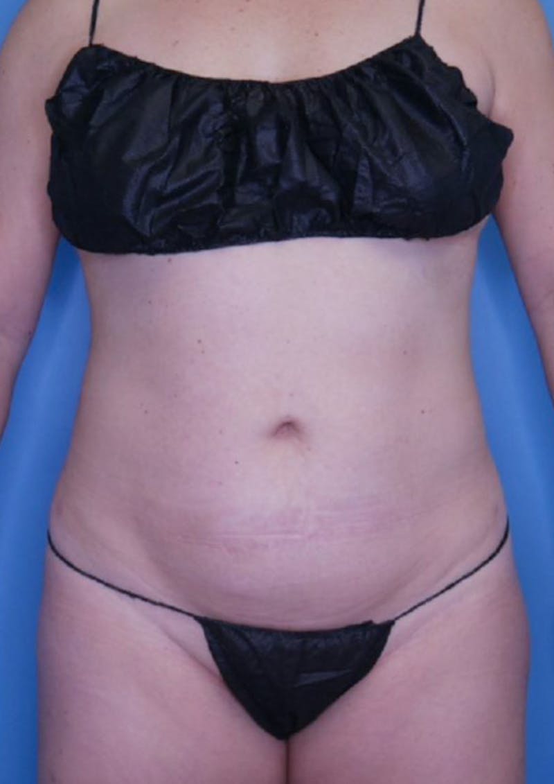 Vaser Liposuction Before & After Gallery - Patient 86837231 - Image 2