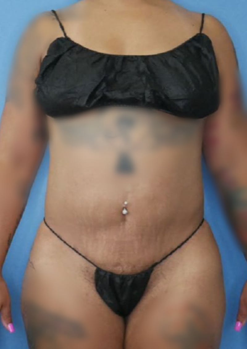 Vaser Liposuction Before & After Gallery - Patient 86837253 - Image 4