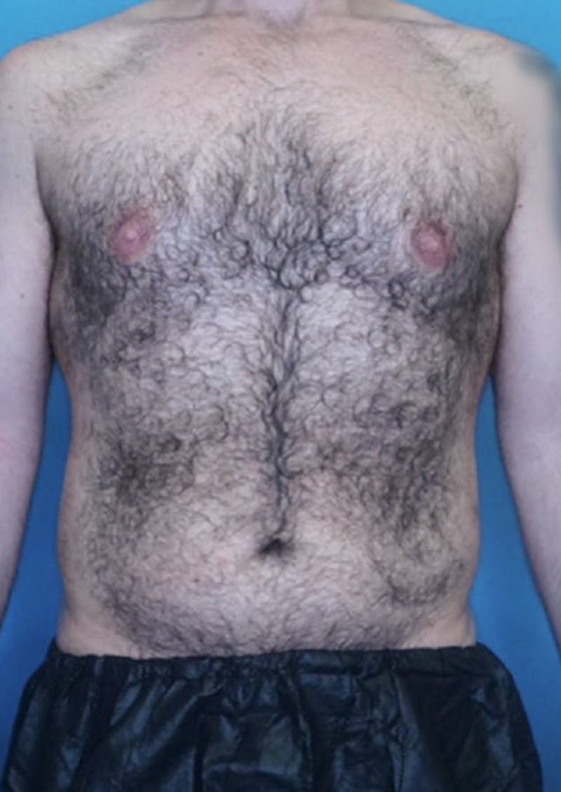 Vaser Liposuction Before & After Gallery - Patient 86837259 - Image 1