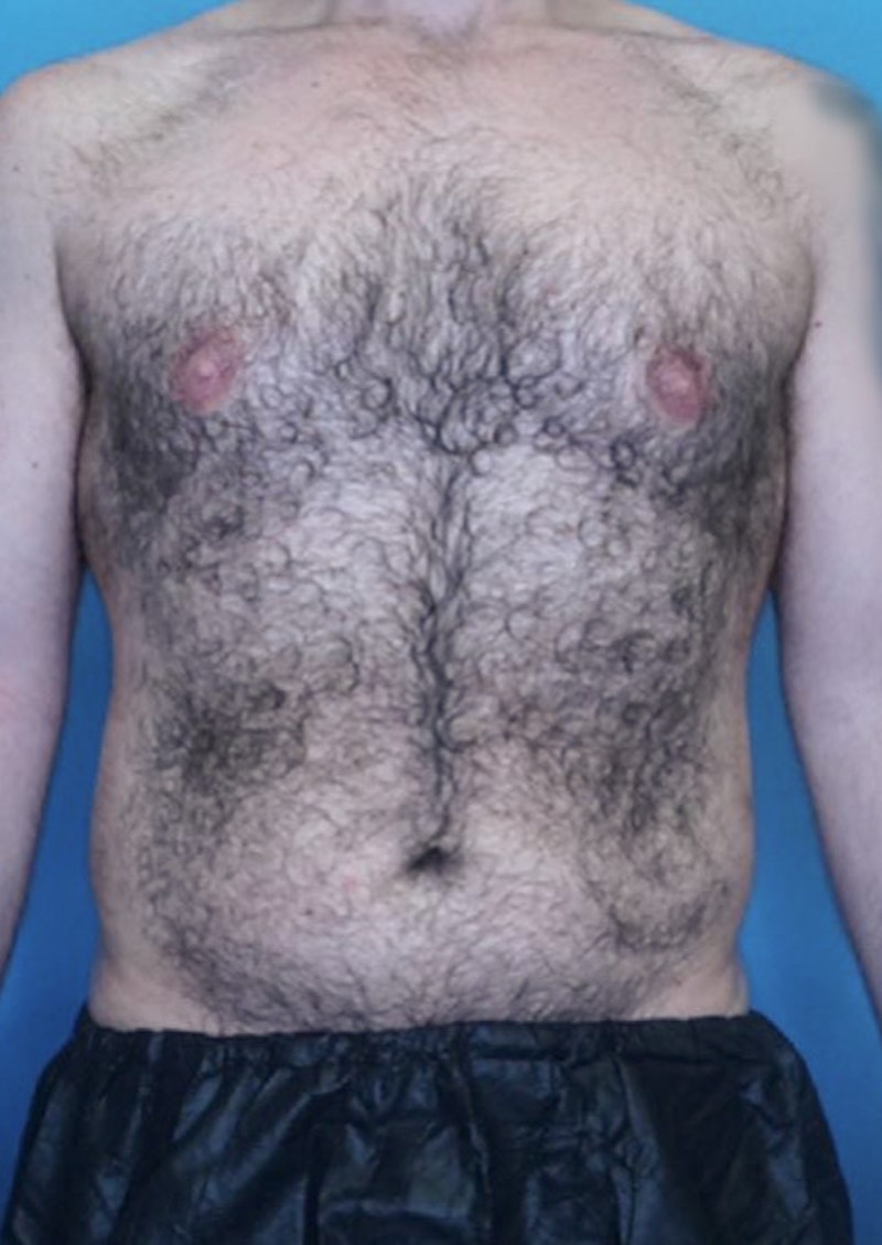 Vaser Liposuction Before & After Gallery - Patient 86837259 - Image 1