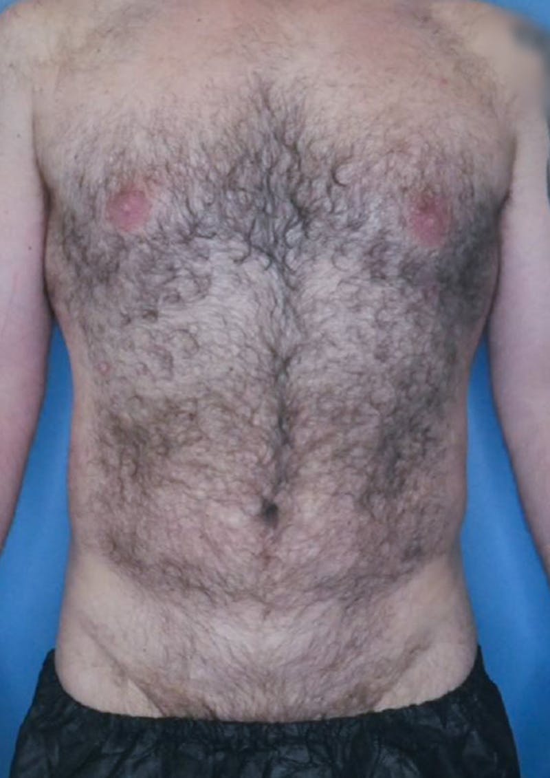 Vaser Liposuction Before & After Gallery - Patient 86837259 - Image 2
