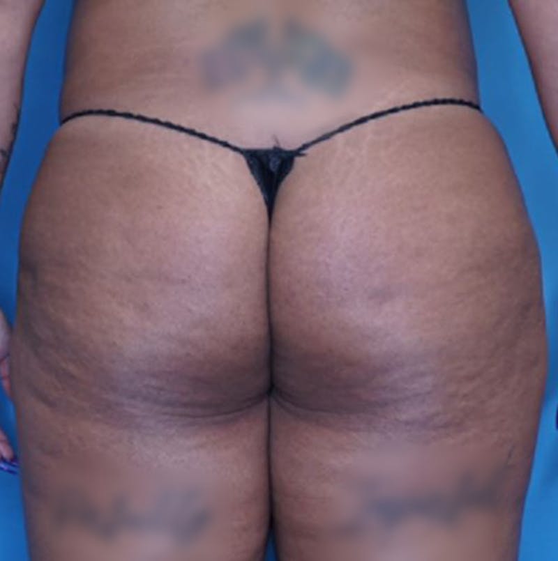 BBL (Brazilian Butt Lift) Before & After Gallery - Patient 86841502 - Image 1