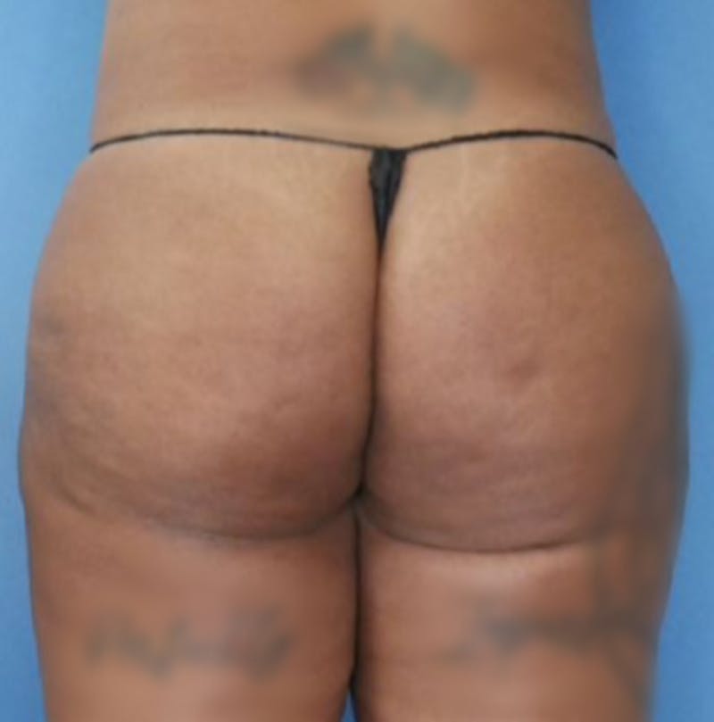BBL (Brazilian Butt Lift) Before & After Gallery - Patient 86841502 - Image 2