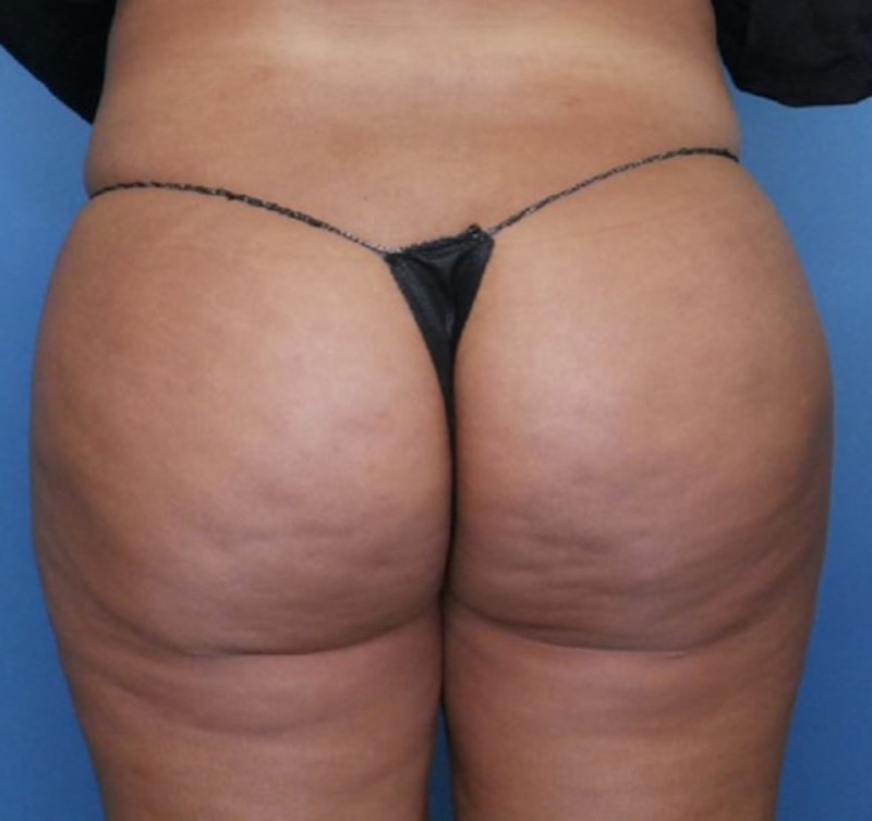 BBL (Brazilian Butt Lift) Before & After Gallery - Patient 86896922 - Image 2