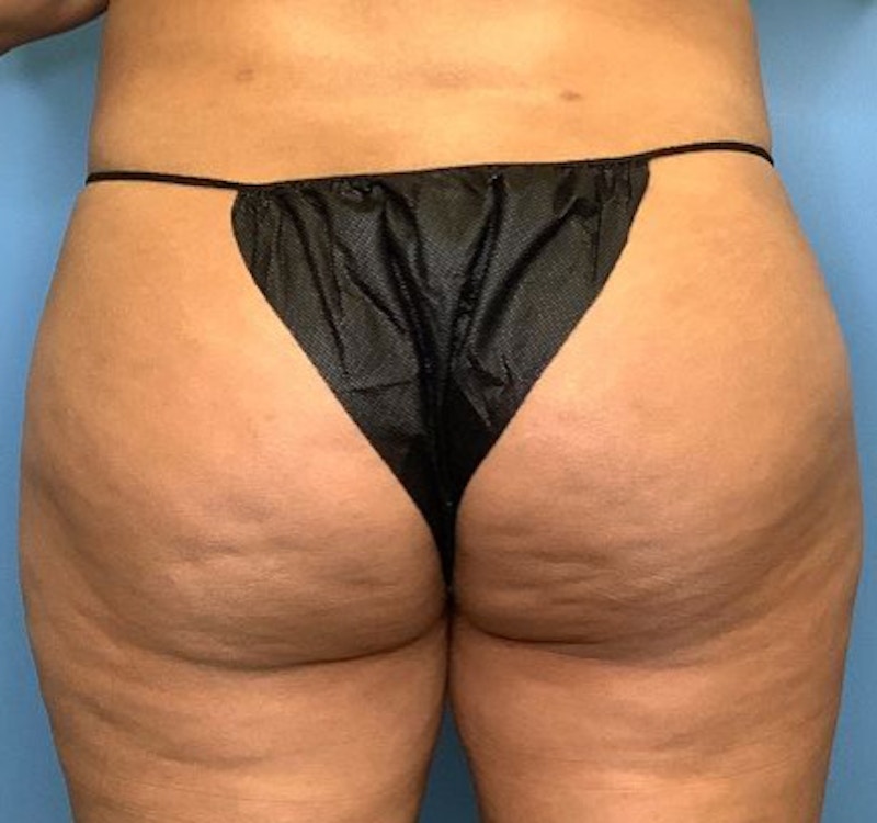 BBL (Brazilian Butt Lift) Before & After Gallery - Patient 86896922 - Image 1