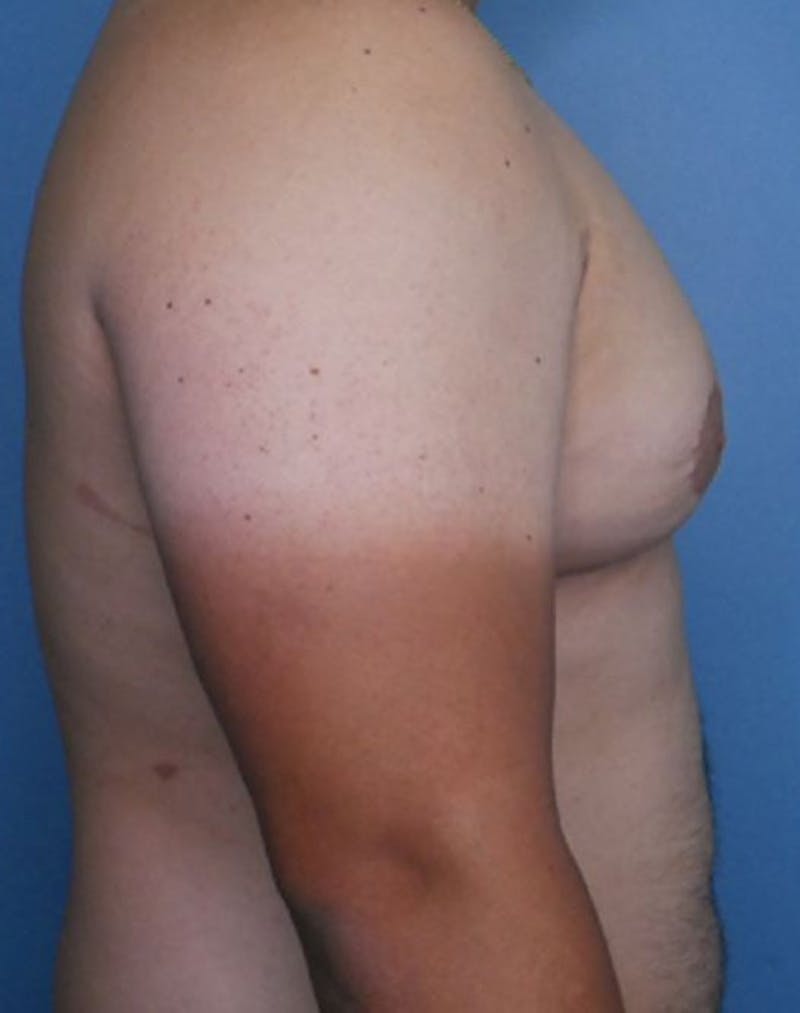 Vaser Liposuction Before & After Gallery - Patient 86896938 - Image 3