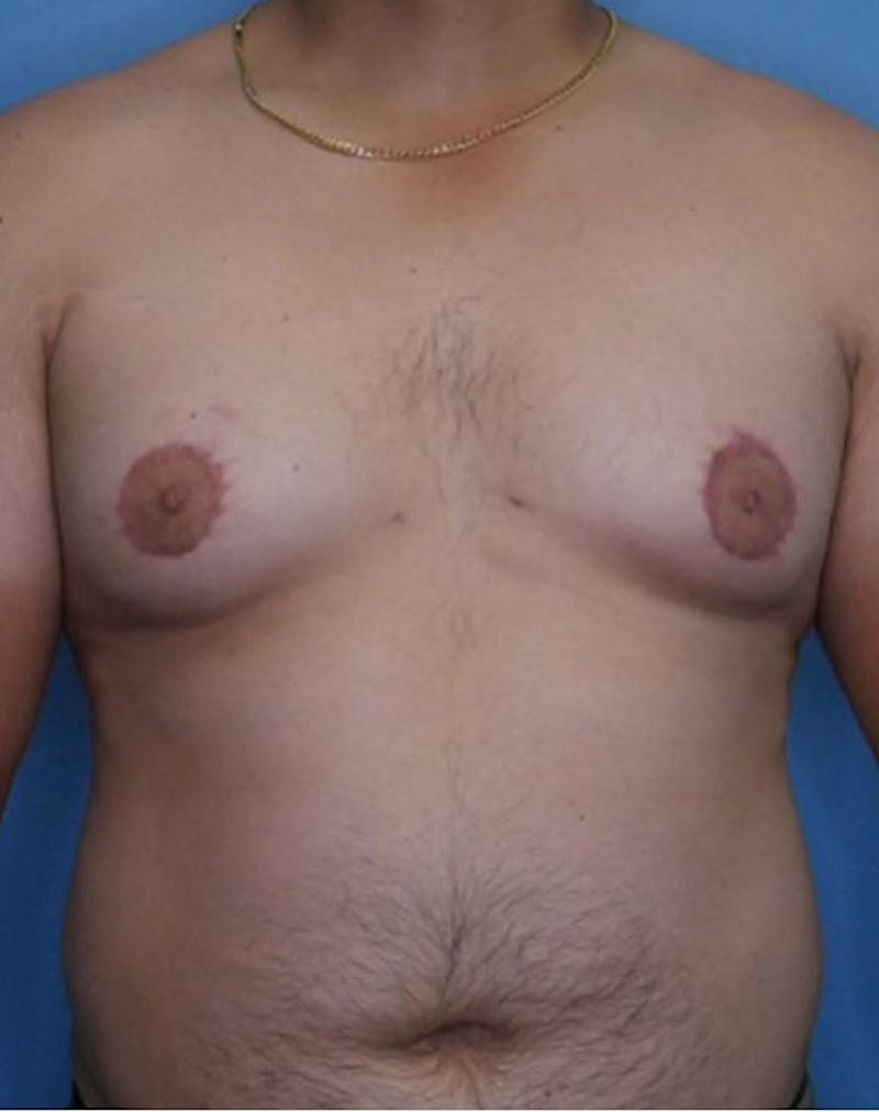Vaser Liposuction Before & After Gallery - Patient 86896938 - Image 1