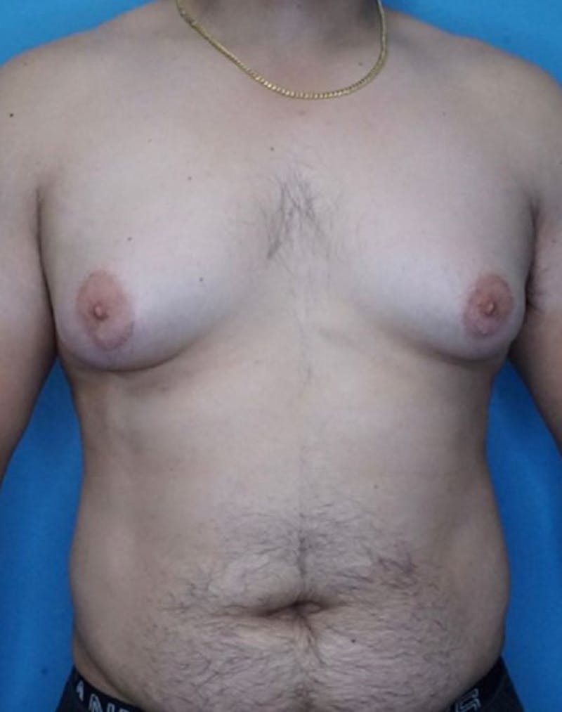 Vaser Liposuction Before & After Gallery - Patient 86896938 - Image 2