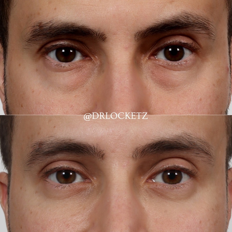 Eyelid Surgery (Blepharoplasty) Before & After Gallery - Patient 100873138 - Image 1
