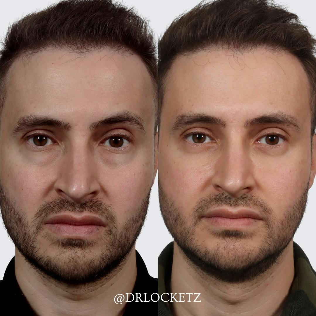 Eyelid Surgery Before & After Gallery - Patient 100873138 - Image 2