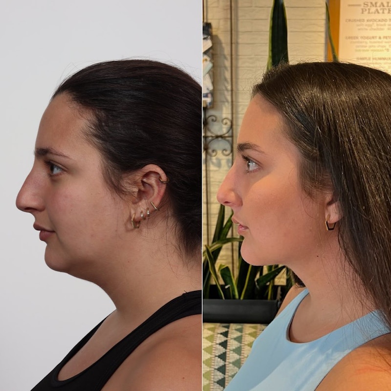 Buccal Fat Reduction Before & After Gallery - Patient 100876981 - Image 1