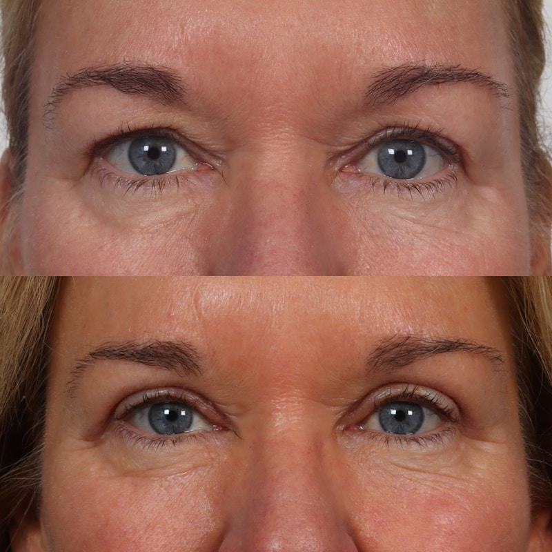 Eyelid Surgery (Blepharoplasty) Before & After Gallery - Patient 100882357 - Image 1