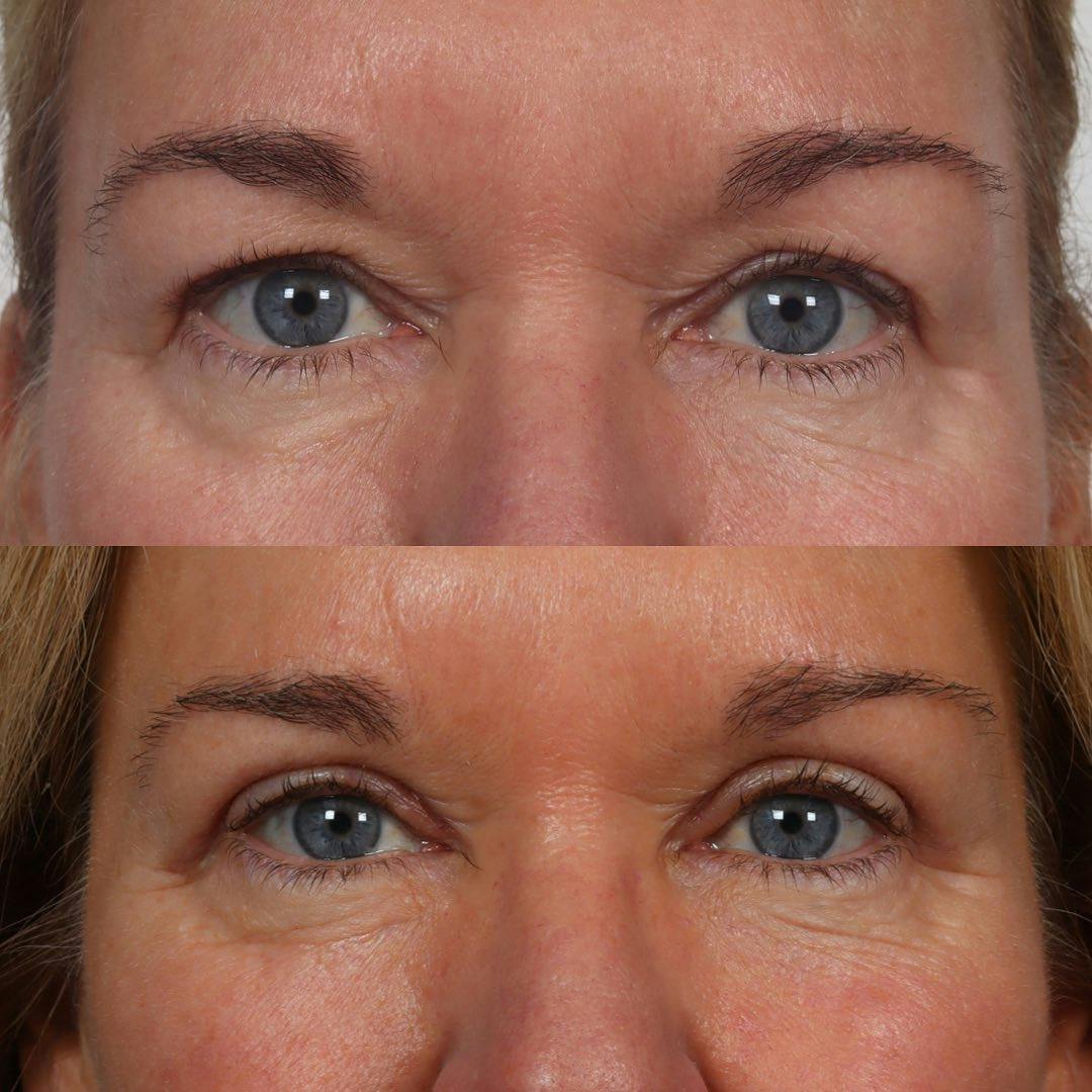 Eyelid Surgery Before & After Gallery - Patient 100882357 - Image 1