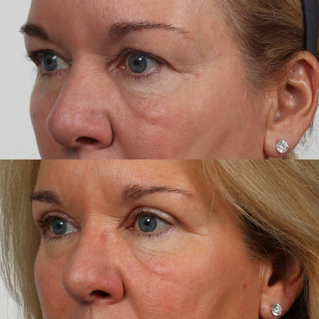 Eyelid Surgery Before & After Gallery - Patient 100882357 - Image 2