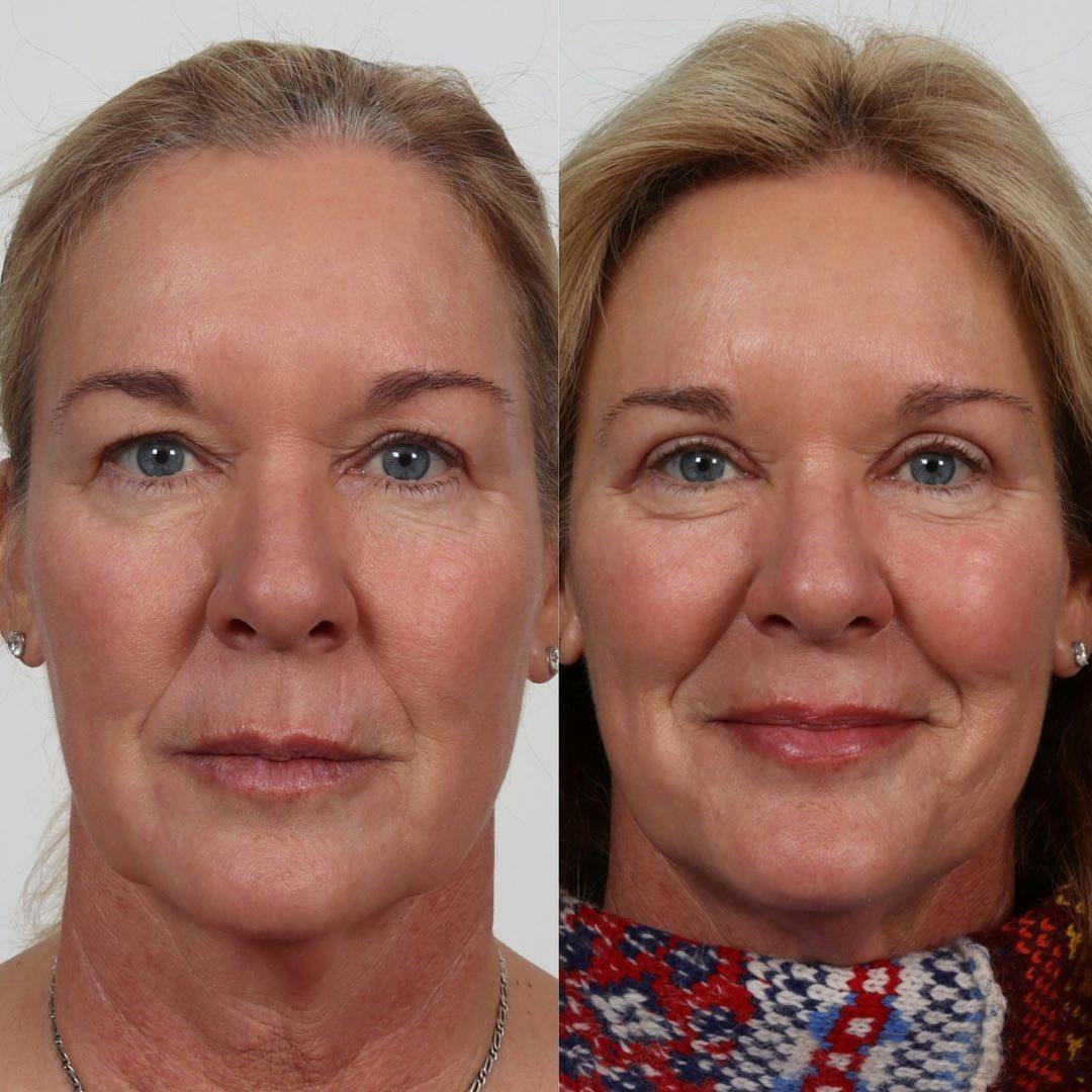 Eyelid Surgery Before & After Gallery - Patient 100882357 - Image 3