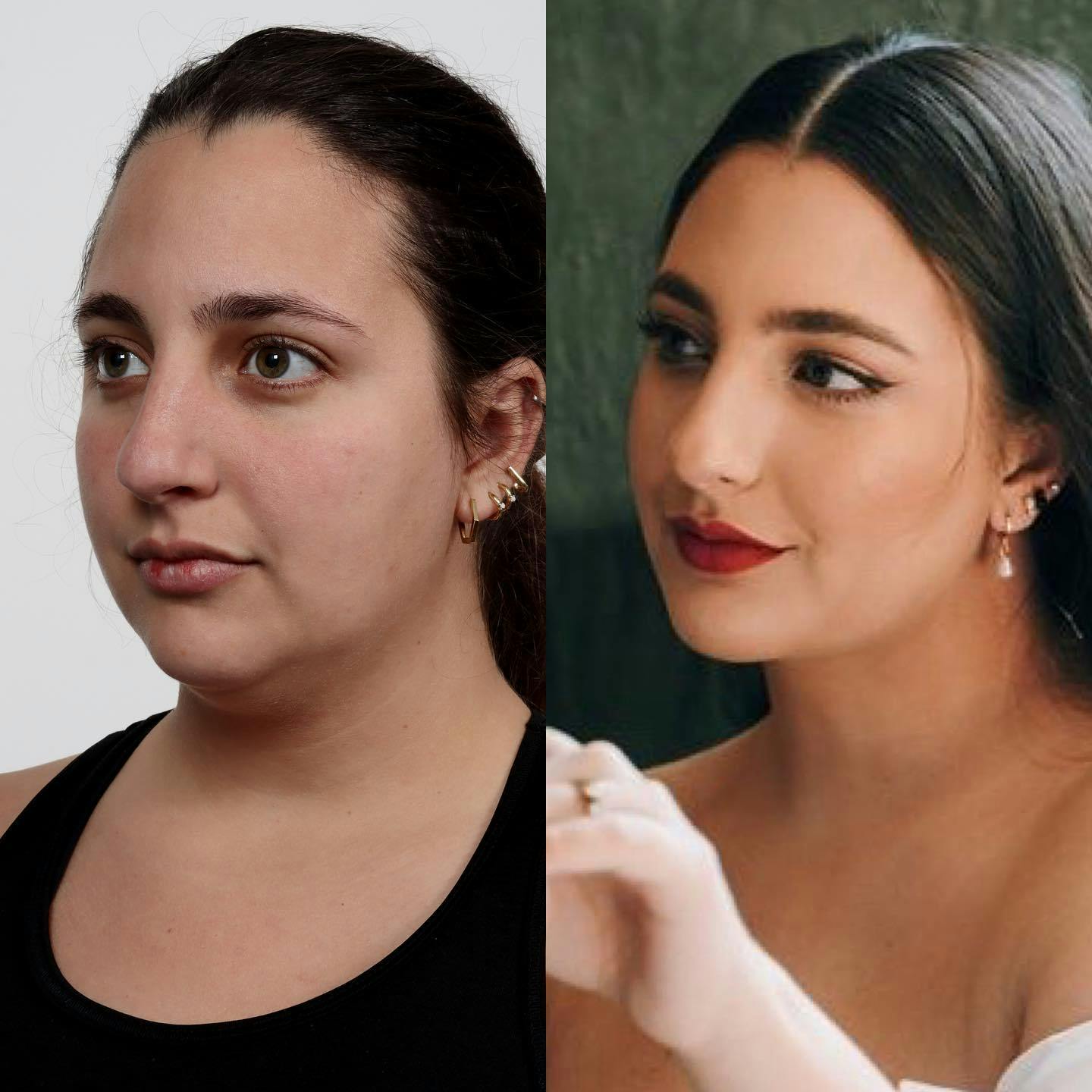 Chin Implant Before & After Gallery - Patient 122965596 - Image 1