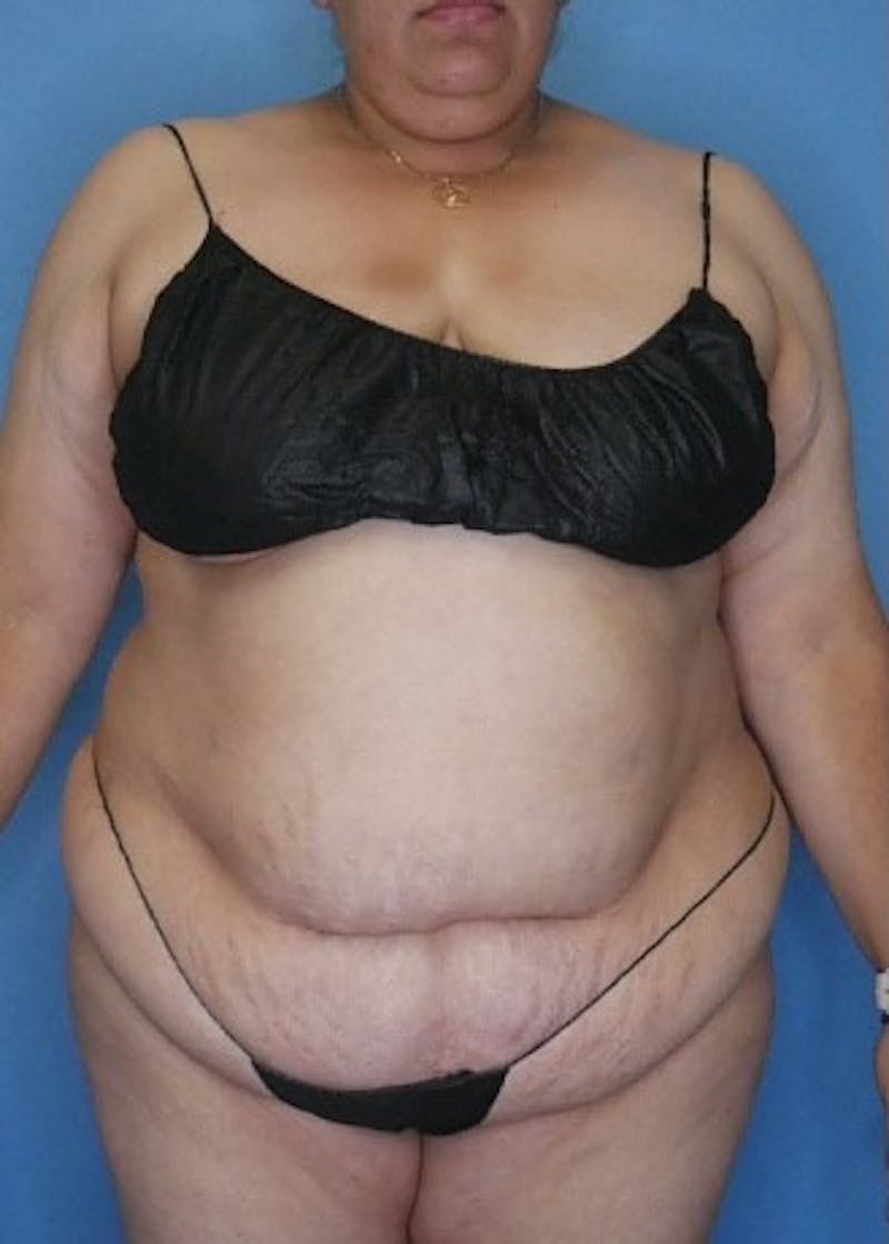 Vaser Liposuction Before & After Gallery - Patient 133182754 - Image 1