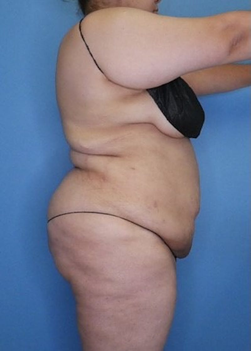 Vaser Liposuction Before & After Gallery - Patient 133182754 - Image 4