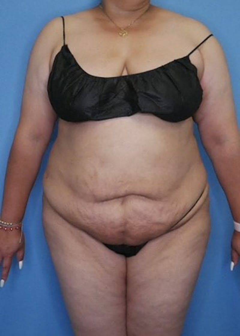 Vaser Liposuction Before & After Gallery - Patient 133182754 - Image 2