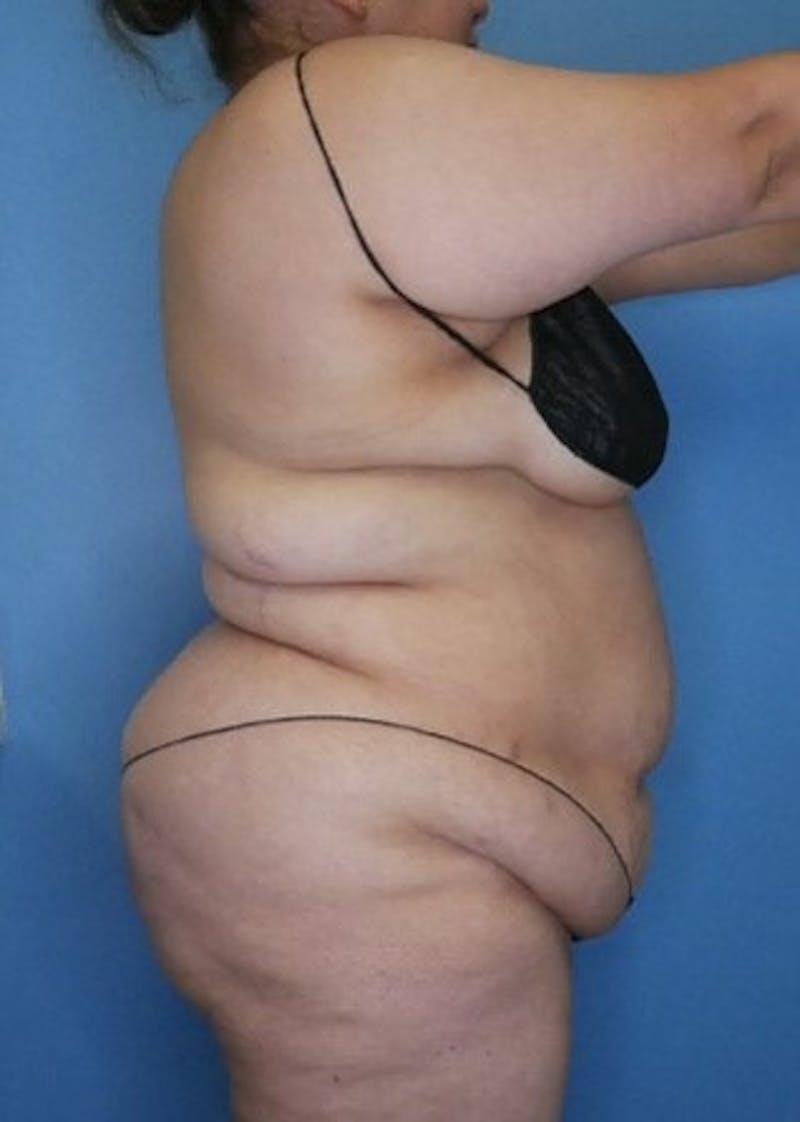 Vaser Liposuction Before & After Gallery - Patient 133182754 - Image 3
