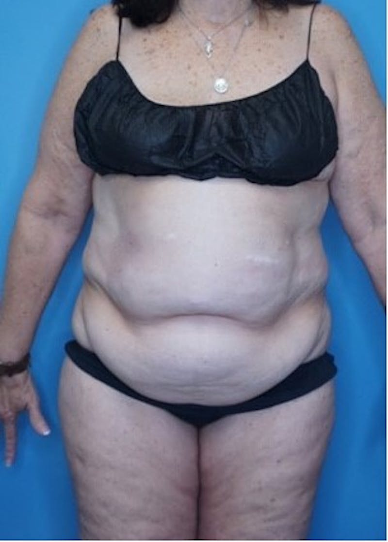 Vaser Liposuction Before & After Gallery - Patient 133182763 - Image 1