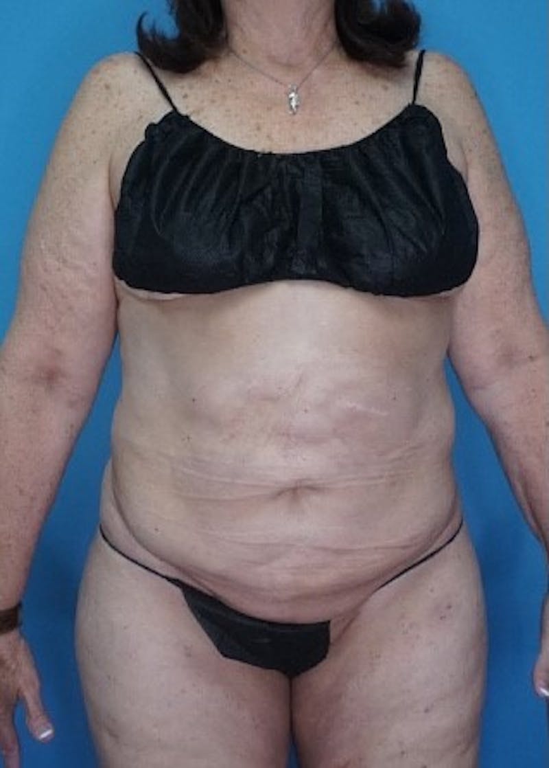 Vaser Liposuction Before & After Gallery - Patient 133182763 - Image 2