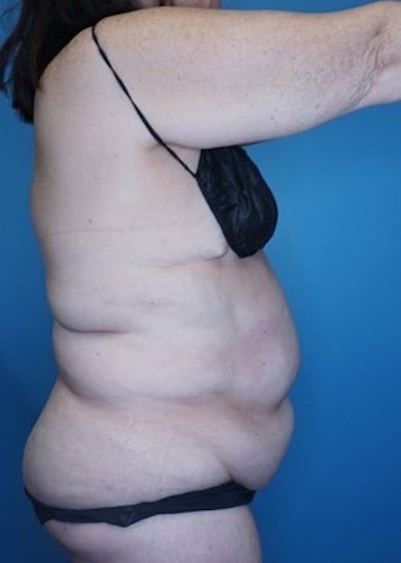 Vaser Liposuction Before & After Gallery - Patient 133182763 - Image 3