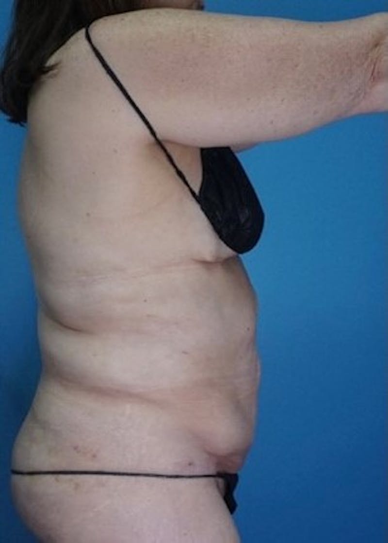 Vaser Liposuction Before & After Gallery - Patient 133182763 - Image 4