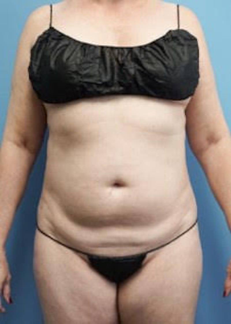 Vaser Liposuction Before & After Gallery - Patient 133182815 - Image 1