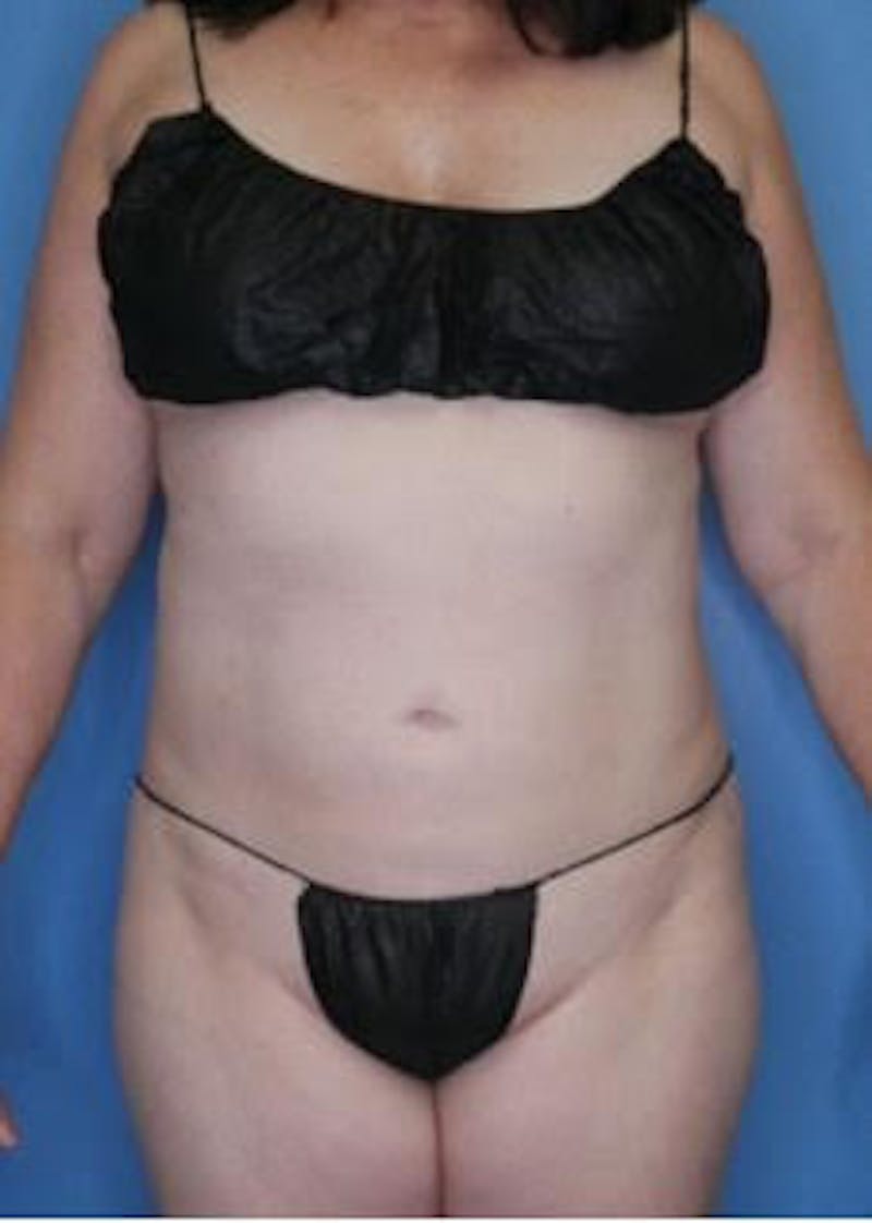 Vaser Liposuction Before & After Gallery - Patient 133182815 - Image 2