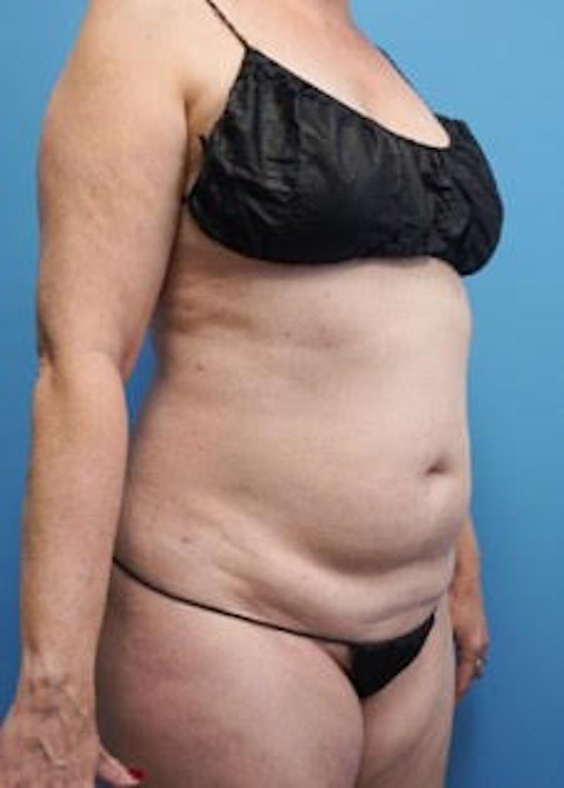 Vaser Liposuction Before & After Gallery - Patient 133182815 - Image 3