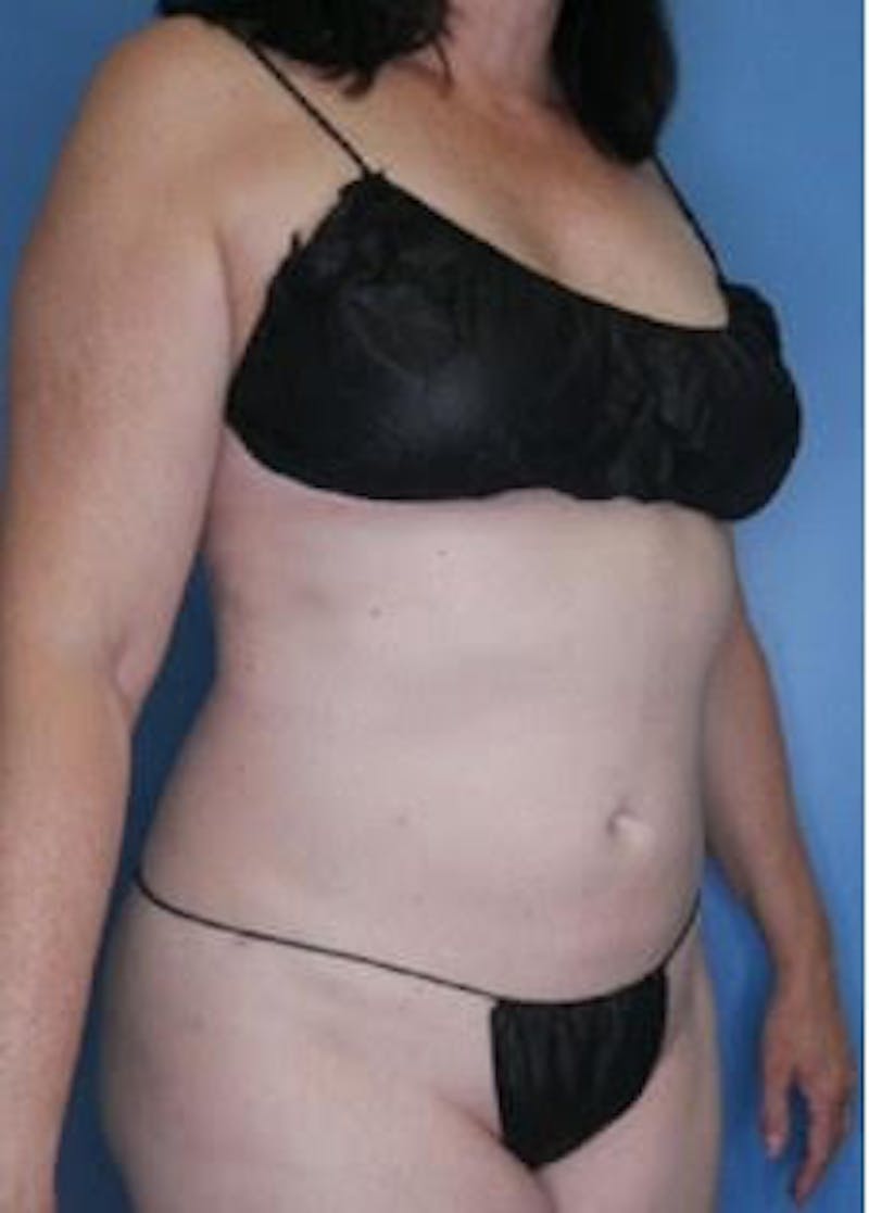 Vaser Liposuction Before & After Gallery - Patient 133182815 - Image 4