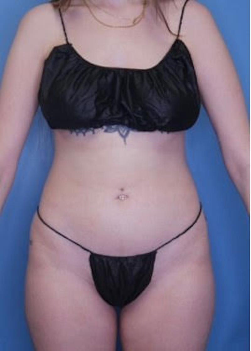 Vaser Liposuction Before & After Gallery - Patient 133182822 - Image 2
