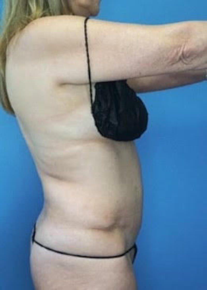 Vaser Liposuction Before & After Gallery - Patient 133182825 - Image 1